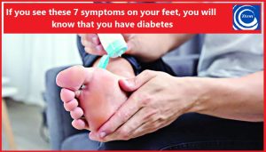 If you see these 7 symptoms on your feet, you will know that you have diabetes