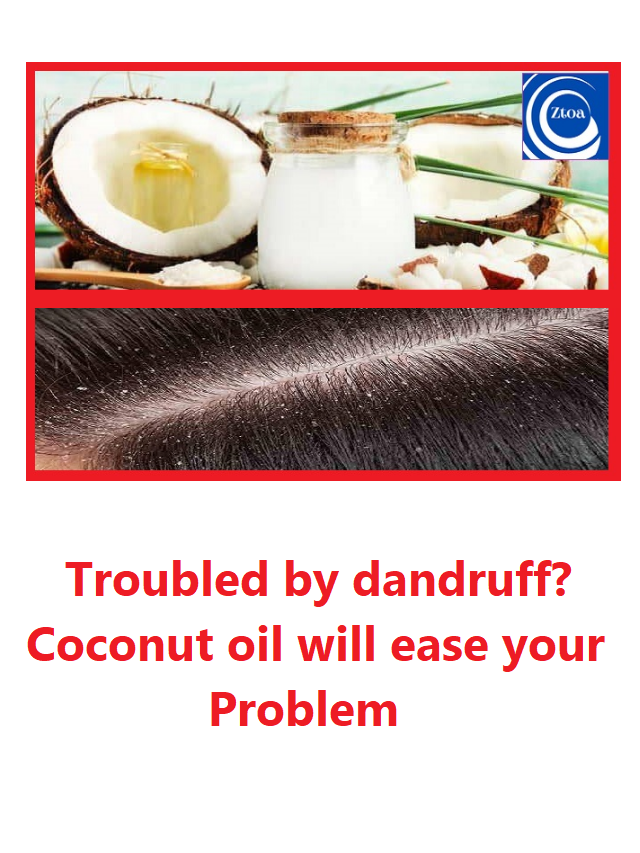 Troubled by dandruff? Coconut oil will ease your problem